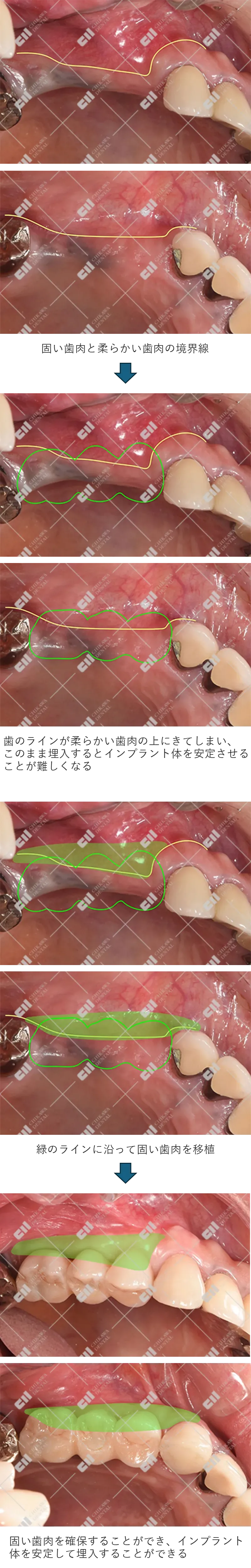 治療中