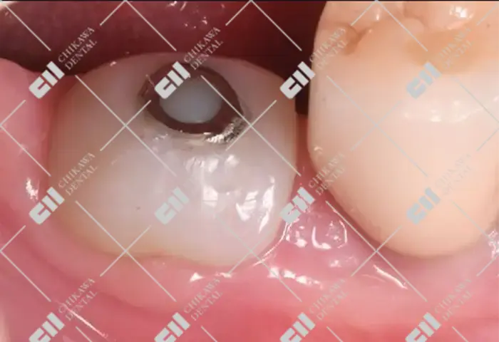 治癒期間