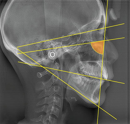 チカワデンタルの歯列矯正分析