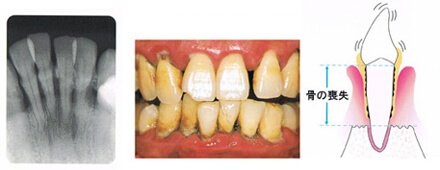 歯周病の進行について 重度の場合