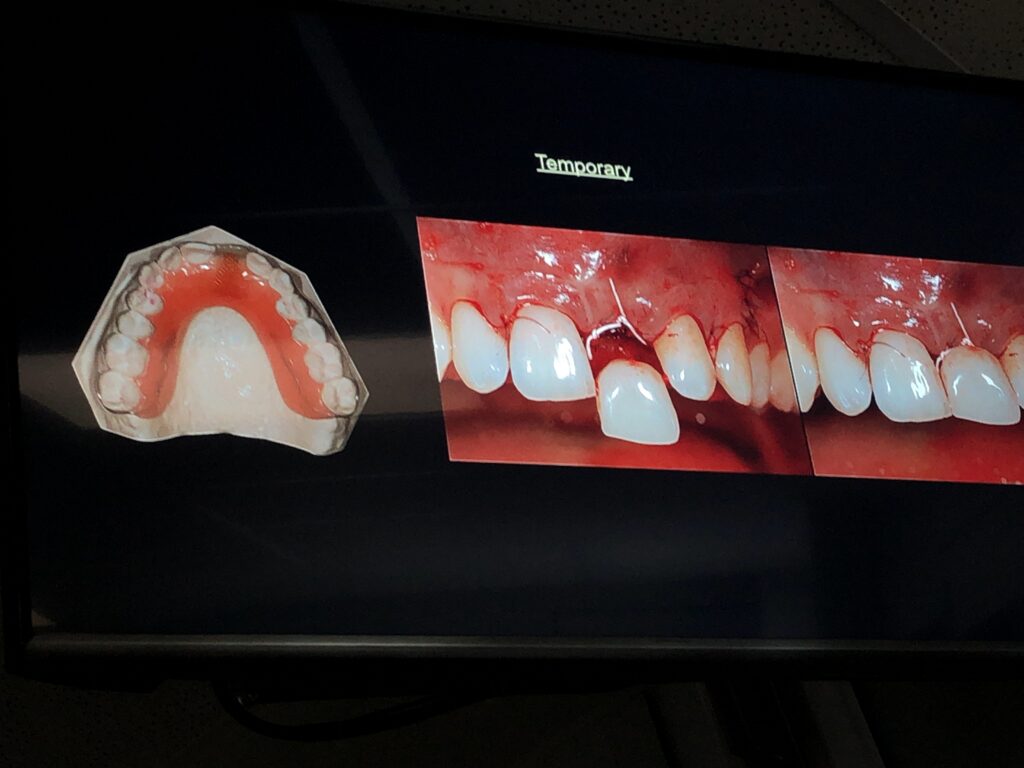 前歯のインプラントに関するスライドが沢山！！