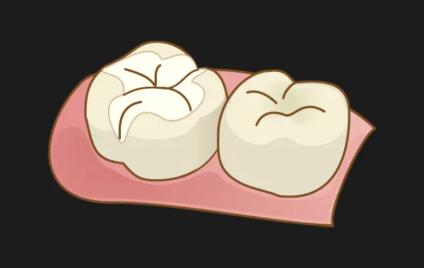 詰め物(インレー)