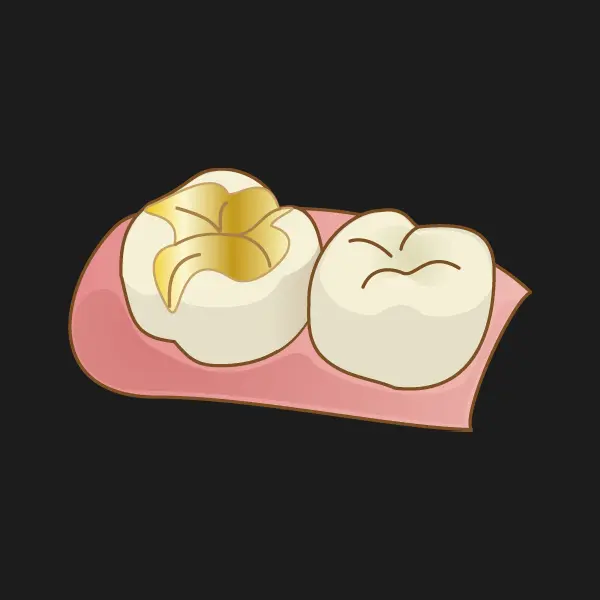 ゴールドインレー