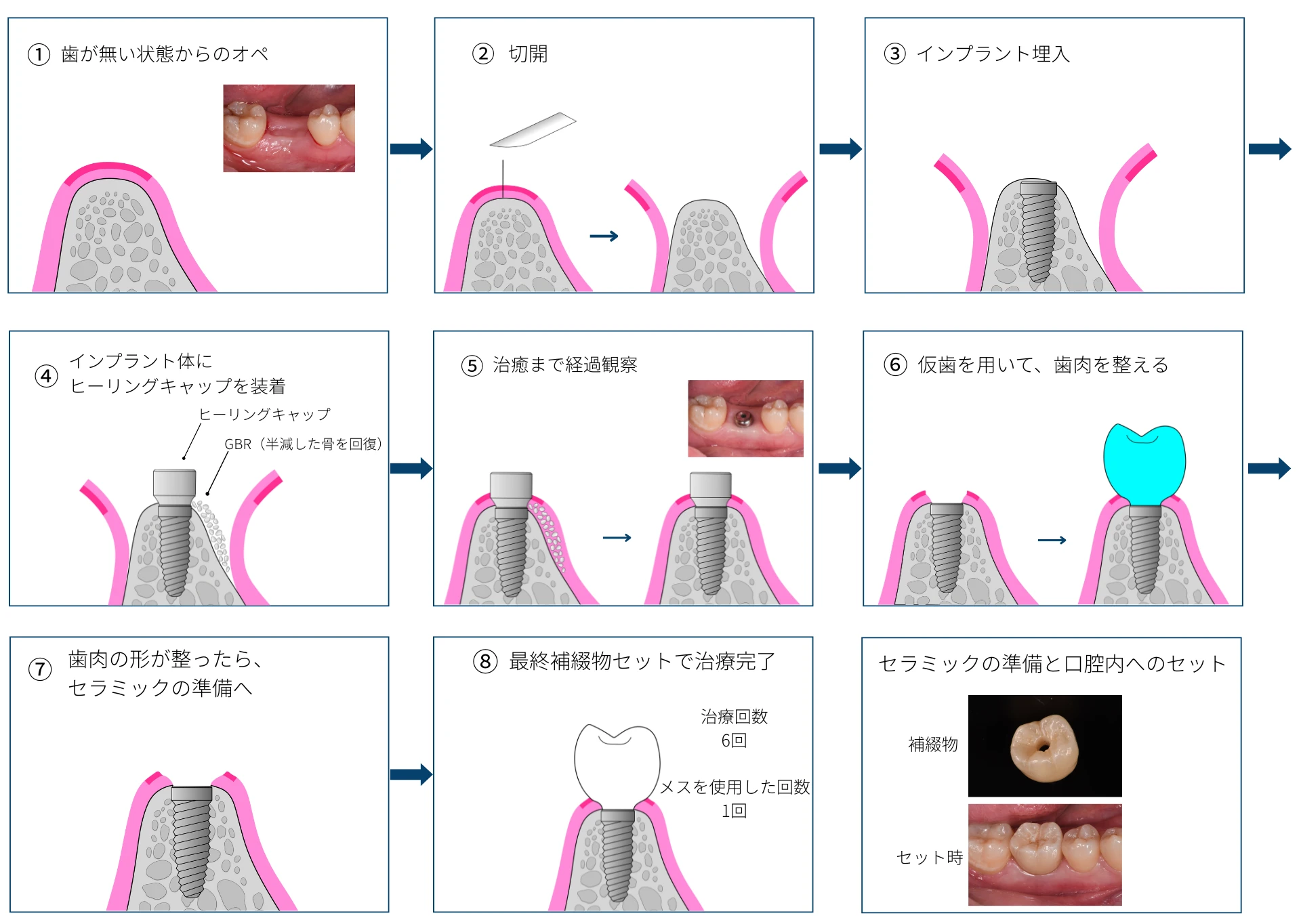 1回法