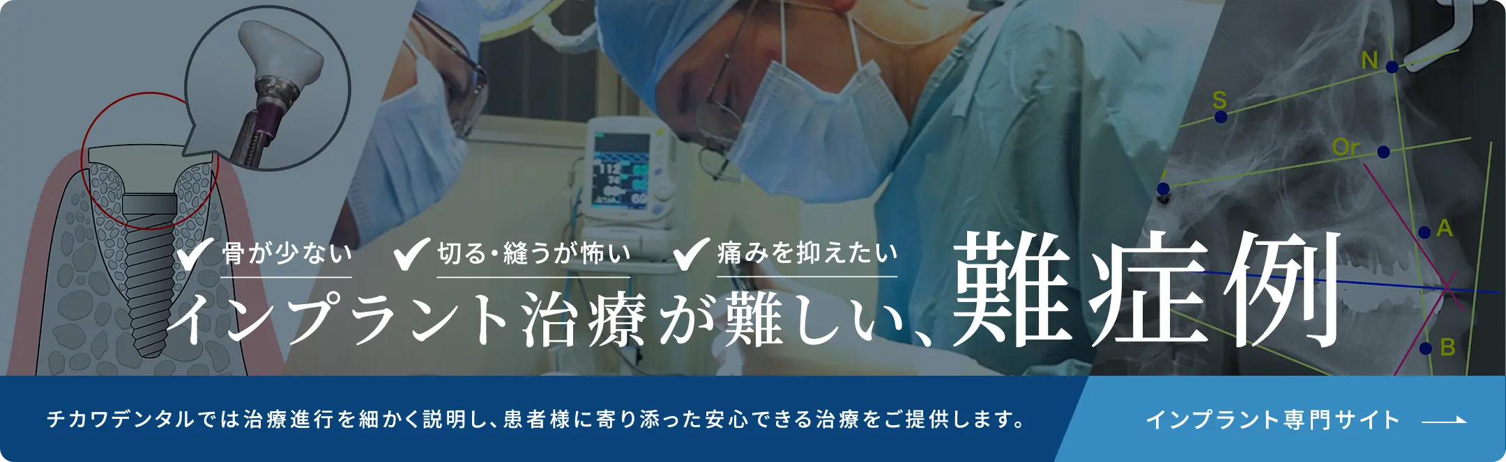 インプラント治療が難しい、難症例だ