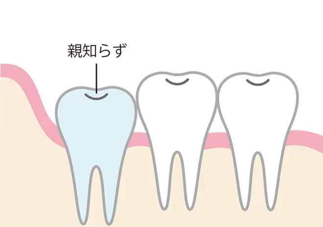 正しくまっすぐ生えていて、ほかの歯や噛み合わせに悪影響がない場合